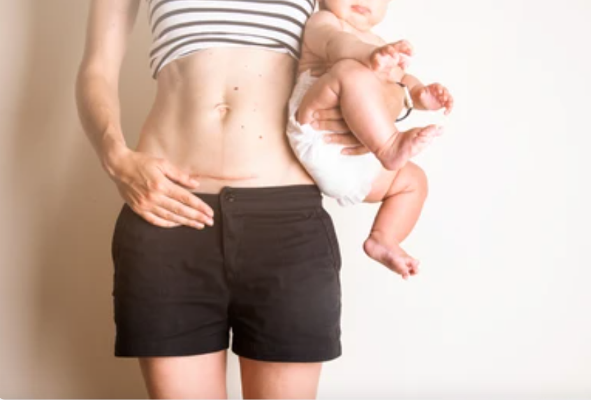 Delayed C-Section and Oxygen Deprivation: Legal Implications in Ontario